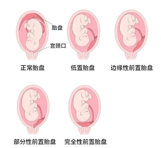 胎盘低置四个月孕妇的应对策略